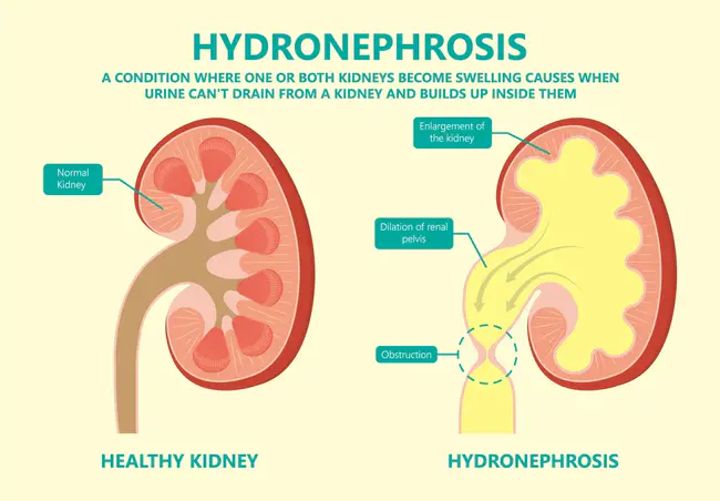 Kidney Ureter And Bladder : 肾输尿管膀胱