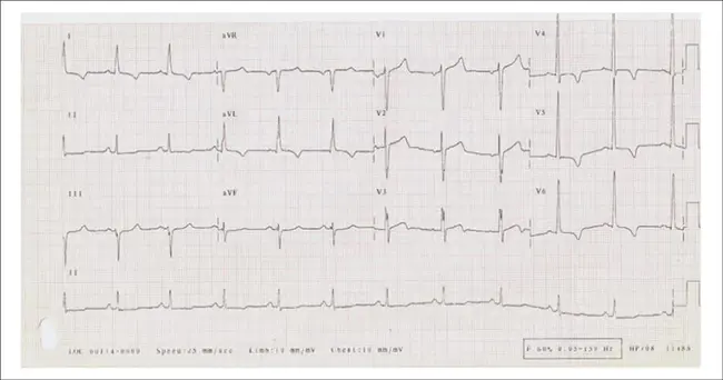 Right Ventricular Systolic Pressure : 右心室收缩压