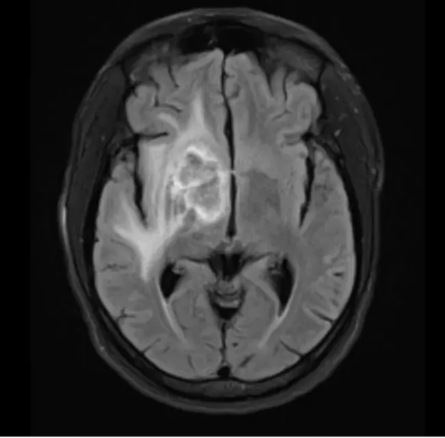 West Nile Virus-associated MeningoEncephalitis : 西尼罗河病毒相关性脑膜脑炎