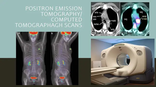 Positron Emission Tomographyanti : 正电子发射断层扫描反