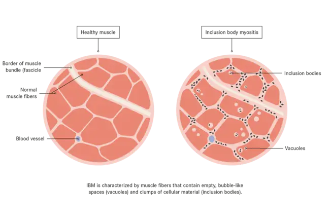 Myositis Association Of America : 美国肌炎协会