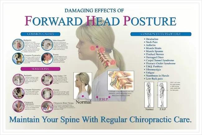 Forward Head Posture : 前头姿势