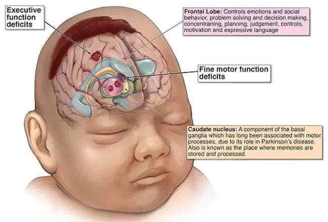 Brain ArterioVenous Malformation : 脑动静脉畸形