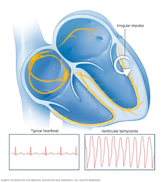 Ventricular Tachicardia : 室性心动过速