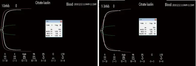 Thrombolysis In Myocardial Infarction : 心肌梗死溶栓