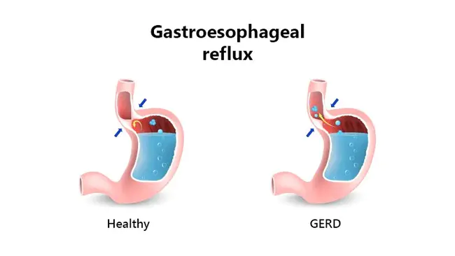 Gastro Esophageal Reflux Disease : 胃食管反流病