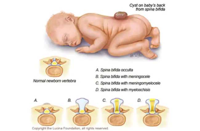 MeningoMyelocele : 脑膜脊髓膨出