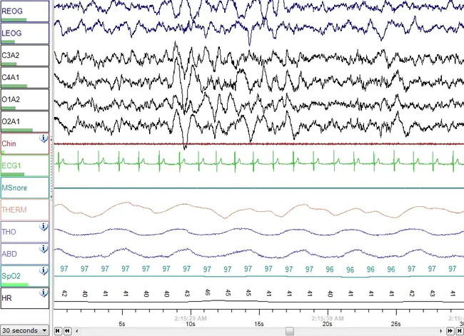 Displaced Sleep Phase Syndrome : 移位睡眠期综合征