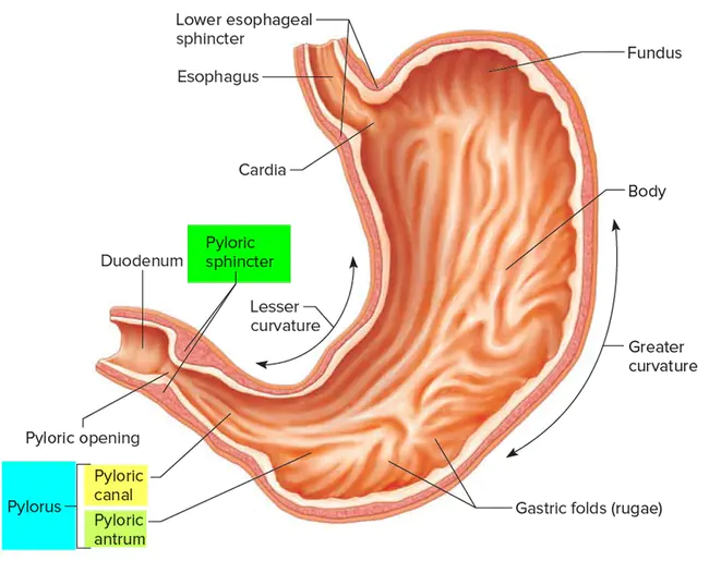 Pyloric Carcinoma And : 幽门癌和