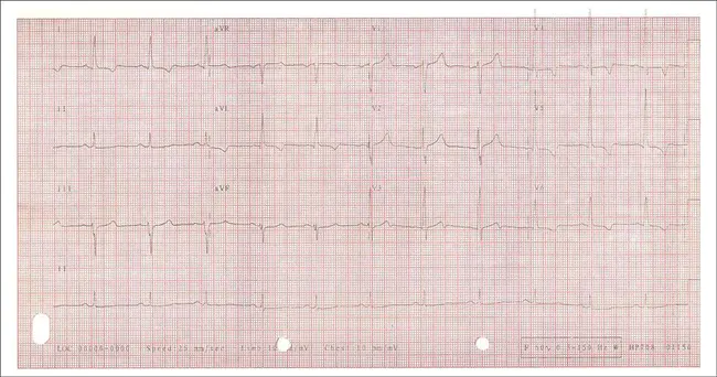 Right Ventricular Diastolic Pressure : 右心室舒张压