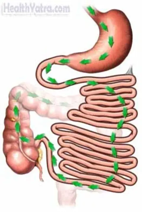 Amoebic Dysentery : 阿米巴痢疾