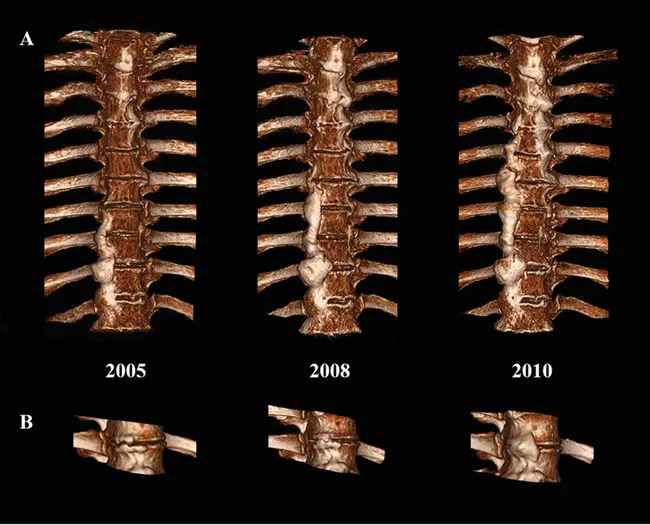 Diffuse Idiopathic Skeletal Hyperostosis Syndrome : 弥漫性特发性骨骼增生综合征