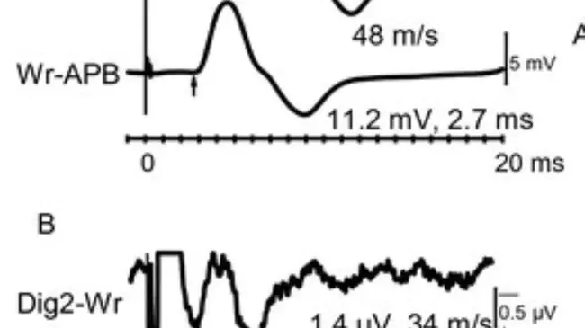 Trial To Assess Chelation Therapy : 螯合疗法评价试验