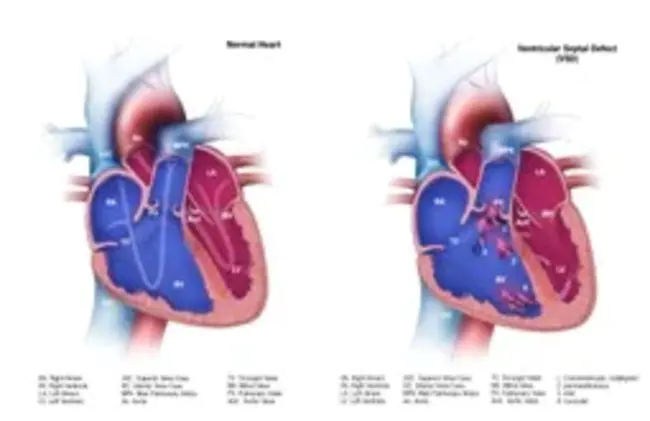 Ventral Septal Defect : 腹间隔缺损