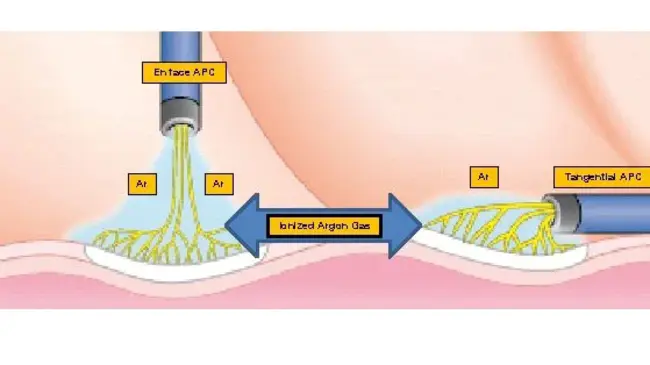 Argon Plasma Coagulation : 氩等离子体凝固