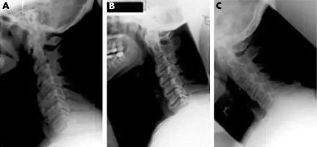 Diffuse Idiopathic Skeletal Hyperostosis : 弥漫性特发性骨骼增生症