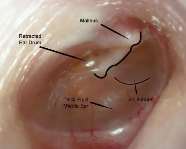 Ear Impression : 耳印模