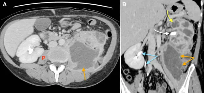 XanthoGranulomatous Pyelonephritis : 黄肉芽肿性肾盂肾炎