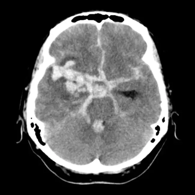 SubArachnoid Hematoma : 蛛网膜下腔血肿