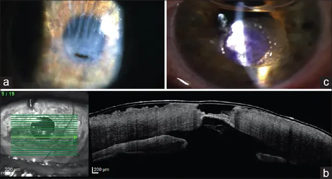 Corneal Molding Therapy : 角膜成型治疗