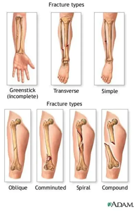 Fracture Critical Member : 断裂临界构件