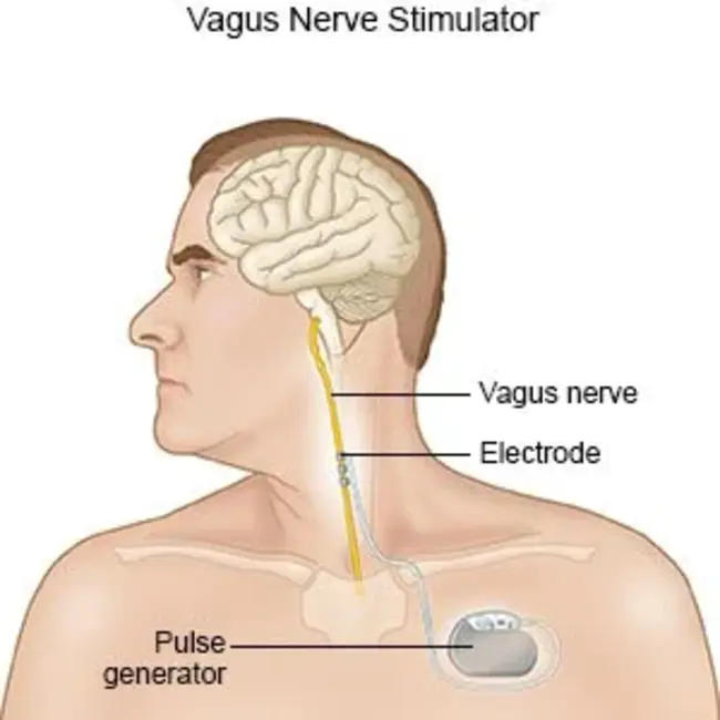 Vagus Nerve Stimulator : 迷走神经刺激器