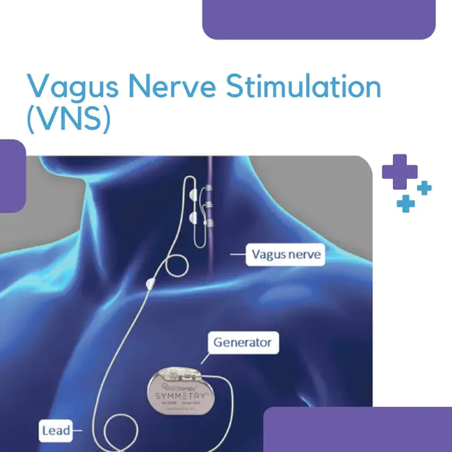 Vagus Nerve Stimulation : 迷走神经兴奋