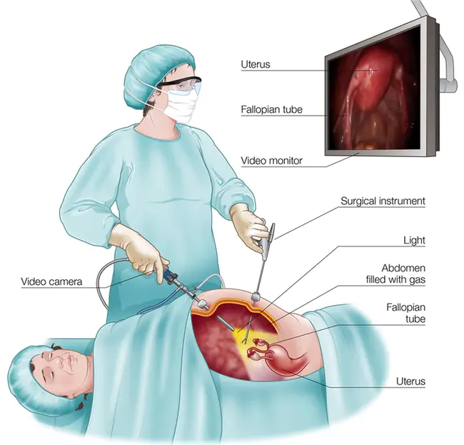 Laparoscopically Assisted Vaginal Hysterectomy : 腹腔镜辅助阴式子宫切除术