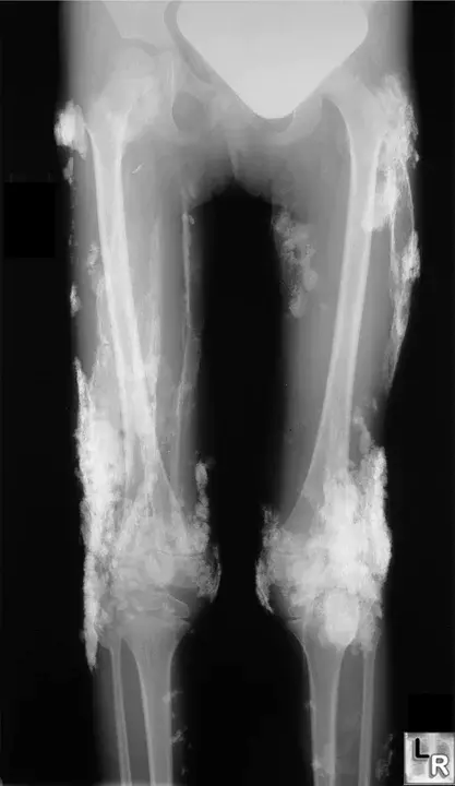 Calcinosis Raynauds Esophagus Sclerodactyly And Telangiectasia : 钙化性粘液样食管硬化和毛细血管扩张