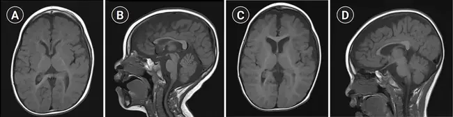 Pediatric Brain Tumor Foundation of the United States : 美国儿童脑肿瘤基金会