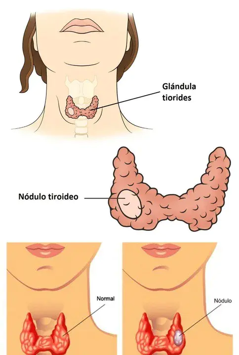 Thyroid Stimulating H : 促甲状腺激素