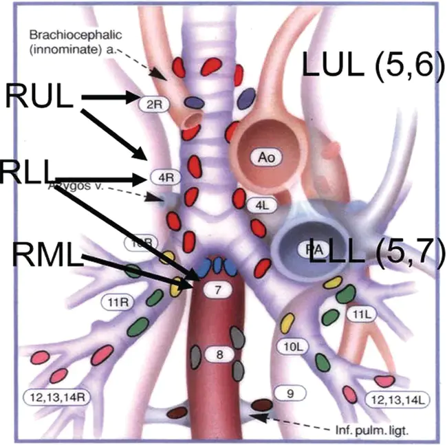 Mediastinal Lymph Node Dissection : 纵隔淋巴结清扫术