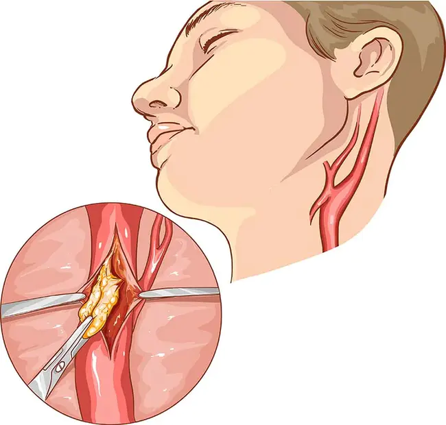 Carotid Endarterectomy : 颈动脉内膜切除术