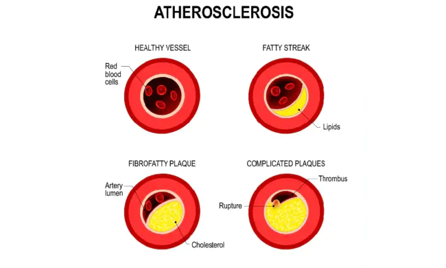 Atherosclerosis Risk In Communities : 社区动脉粥样硬化风险