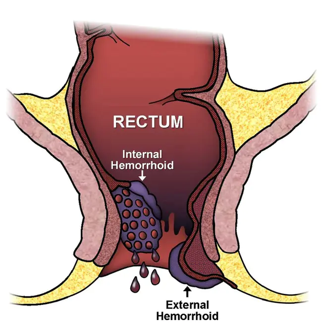 Hemorrhoid : 痔疮