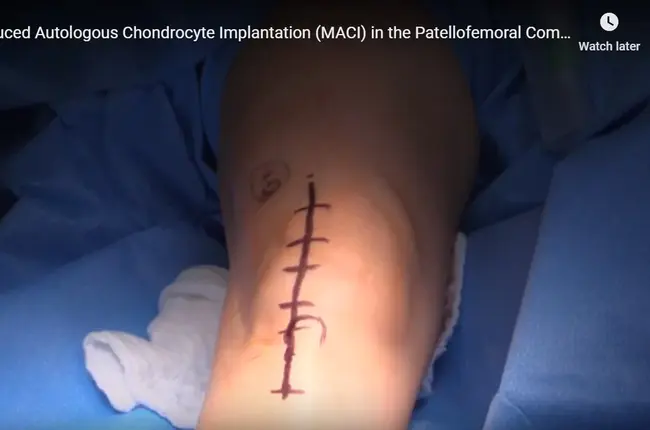 Matrix-Induced Chondrocyte Implantation : 基质诱导软骨细胞植入