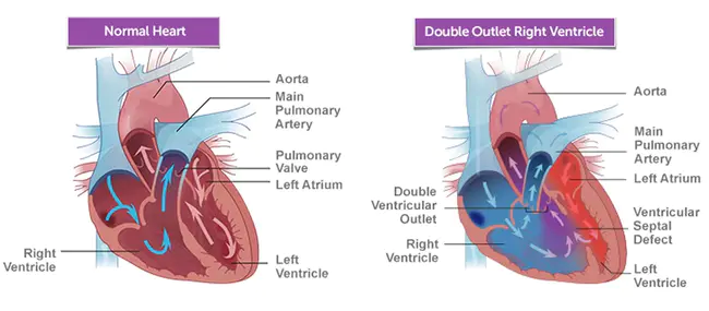 Right Ventr Pacing : 右腹肌起搏