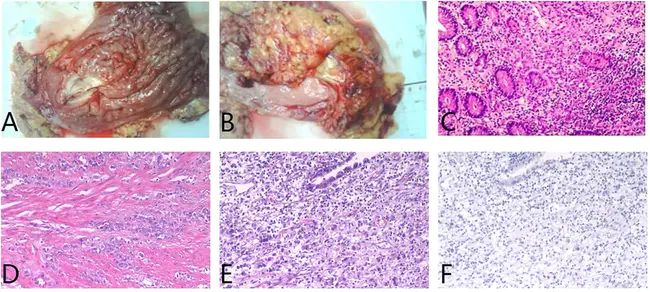 Human Gastric Carcinoma Cell : 人胃癌细胞