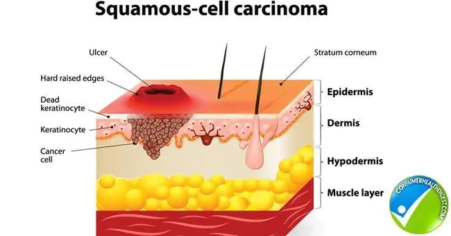 Primary Peritoneal Carcinoma : 原发性腹膜癌