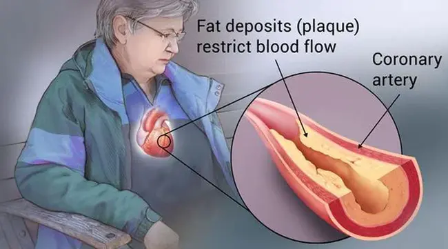 Coronary Arteriosclerotic Heart Disease : 冠状动脉硬化性心脏病