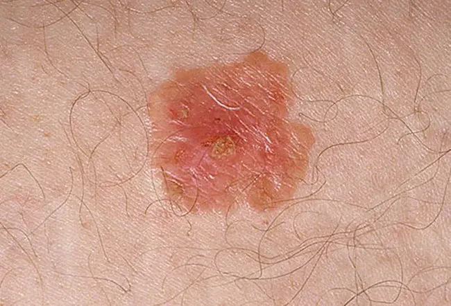 Non-Melanoma Skin : 非黑色素瘤皮肤