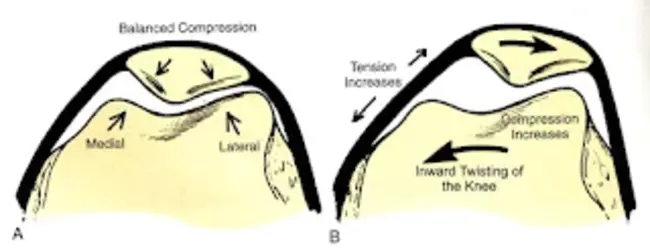 Patella Femoral Syndrome : 髌骨股骨综合症