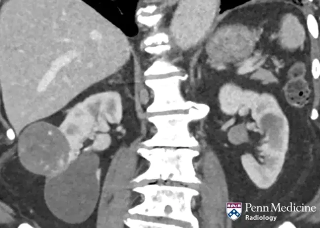 International Subarachnoid Aneurysm Trial : 国际蛛网膜下腔动脉瘤试验