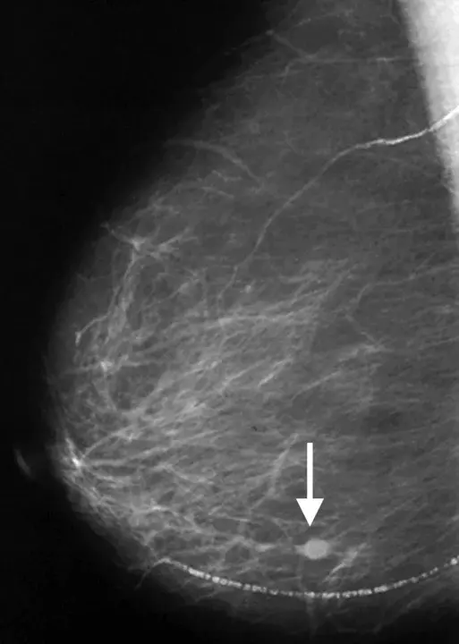 Mammographic Image Analysis Society : 乳腺影像分析学会