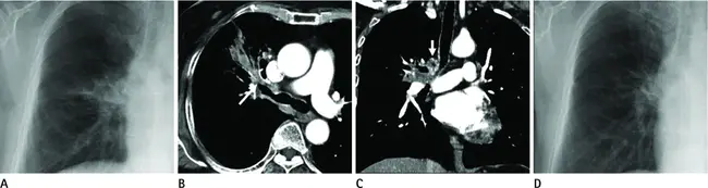 Left Mainstem Bronchus Occlusion : 左主干支气管阻塞