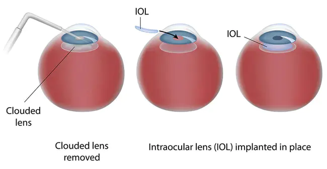 Intraocular Contact Lens : 眼内接触镜