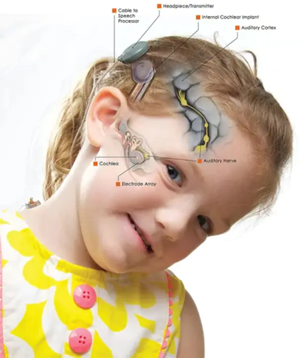 Cochlear Implant Centrums Olsztyn : 耳蜗植入中心