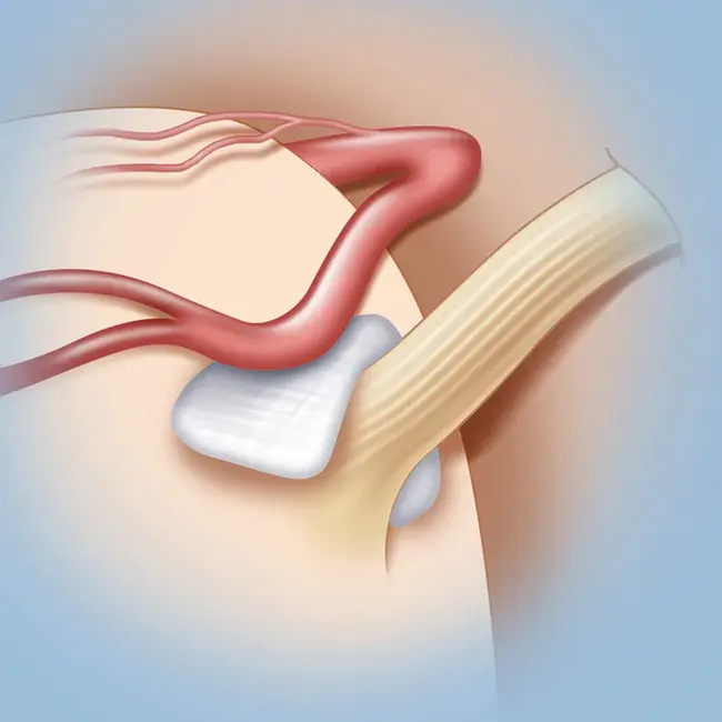 Trigeminal Neuralgia : 三叉神经痛