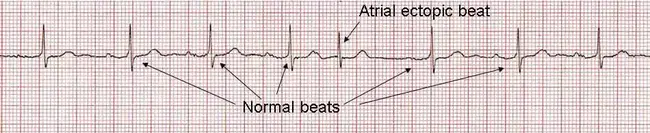 Ectopic Atrial Tachycardia : 异位房性心动过速