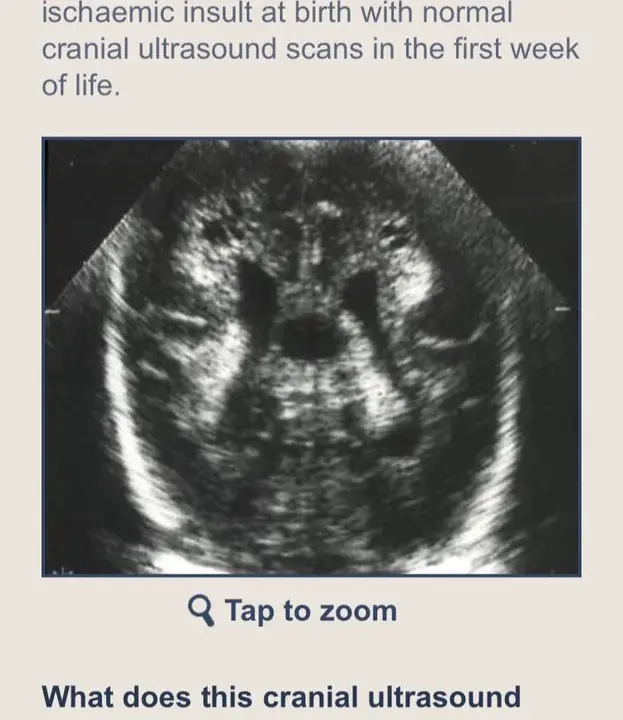 Congenital Bilateral Perisylvian Syndrome : 先天性双侧锁骨周围综合征